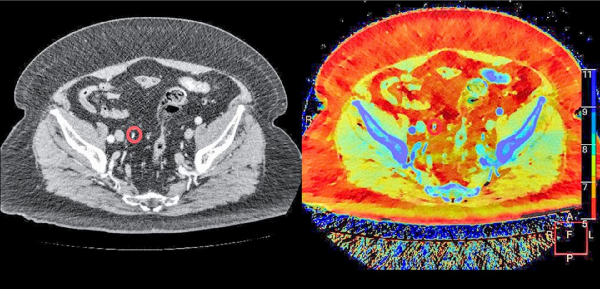 Mit dem Bild des Spectral-CTs (Bild rechts) ist der Harnstein im roten Kreis besser erkennbar als mit einem herkömmlichen CT. Die Farbe zeigt auch das Material des Steins an (Calciumoxolat). BILD: ZVG