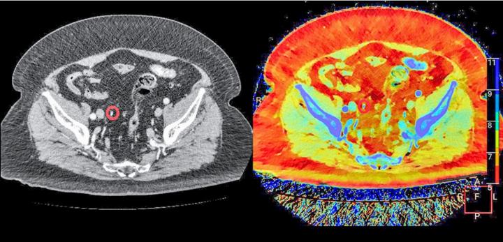 Mit dem Bild des Spectral-CTs (Bild rechts) ist der Harnstein im roten Kreis besser erkennbar als mit einem herkömmlichen CT. Die Farbe zeigt auch das Material des Steins an (Calciumoxolat). BILD: ZVG